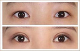 好的纳米双眼皮制作公司推荐，做韩式纳米双眼皮价格