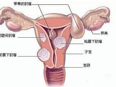 山东qw的子宫肌瘤zl：子宫腺肌瘤的zl方法