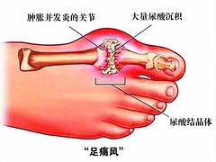 山东膝关节退行性病变中药治疗|天道中医_专业的膝关节退行性病变中药治疗机构