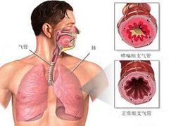 支气管炎治疗专业报价：支气管炎的治疗方法